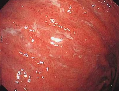 ピロリ菌に感染した胃粘膜のびまん性発赤が認められます。 ところどころ赤くただれているのがわかります。