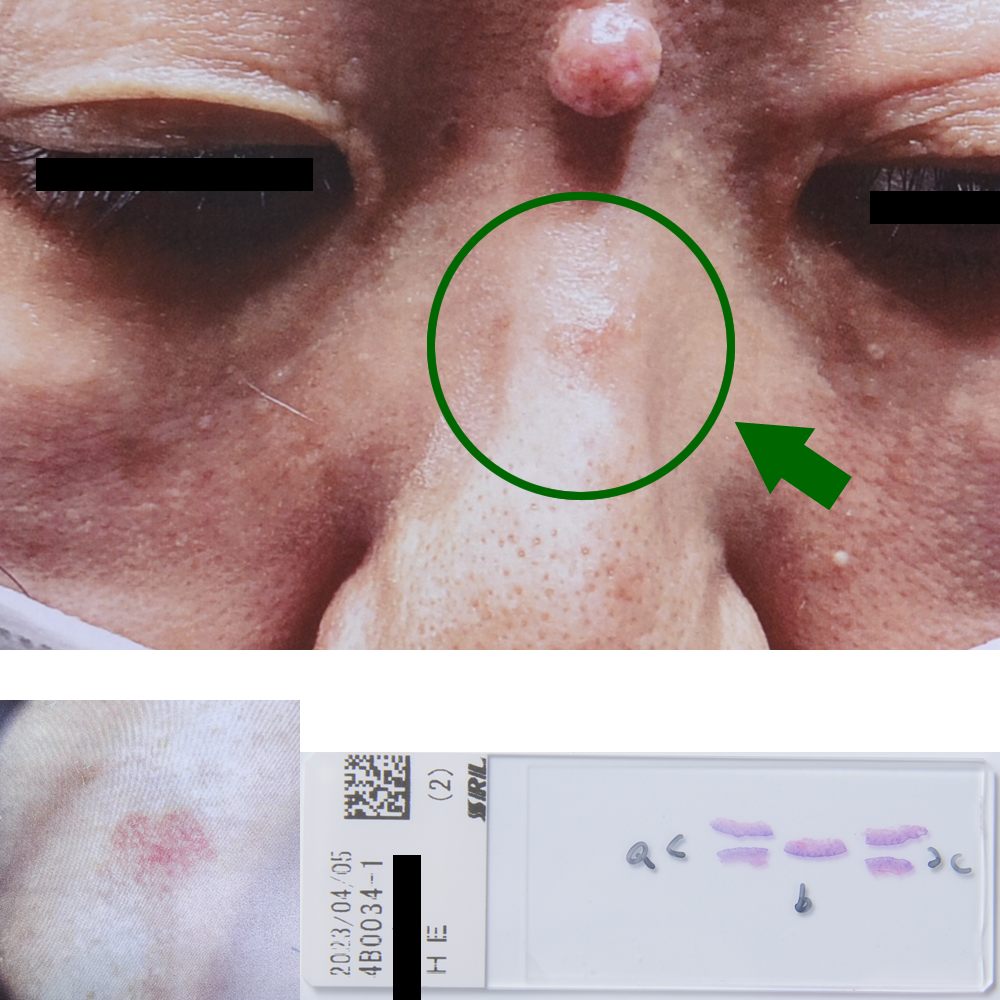 日光角化症（前癌状態）｜52才女性｜鼻背部