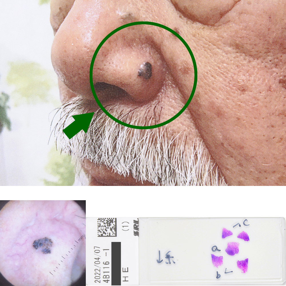 74才男性　左鼻翼部