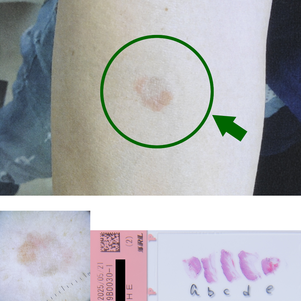 ボーエン癌|45才男性|右前腕部
