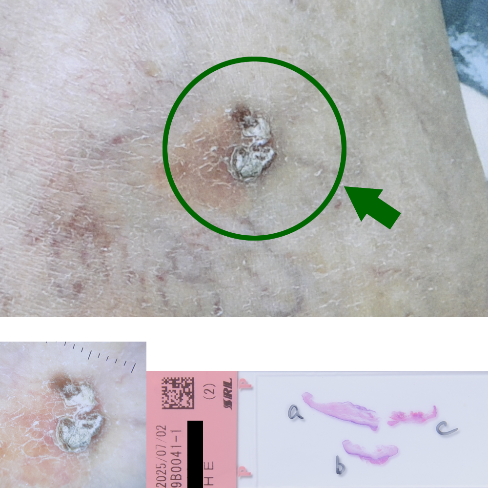 ボーエン癌|78才男性|右足関節部