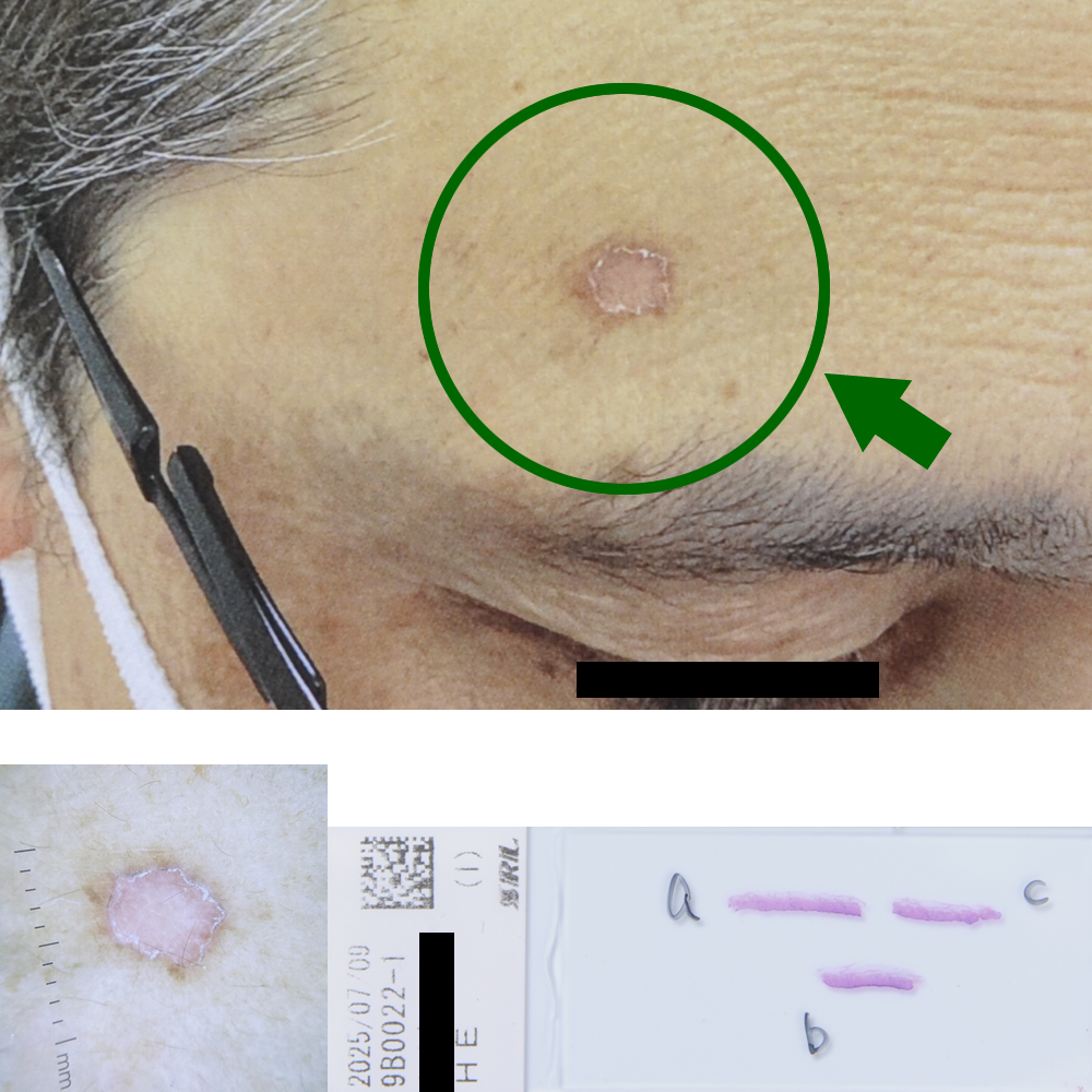 汗孔角化症|54才男性|右前額部