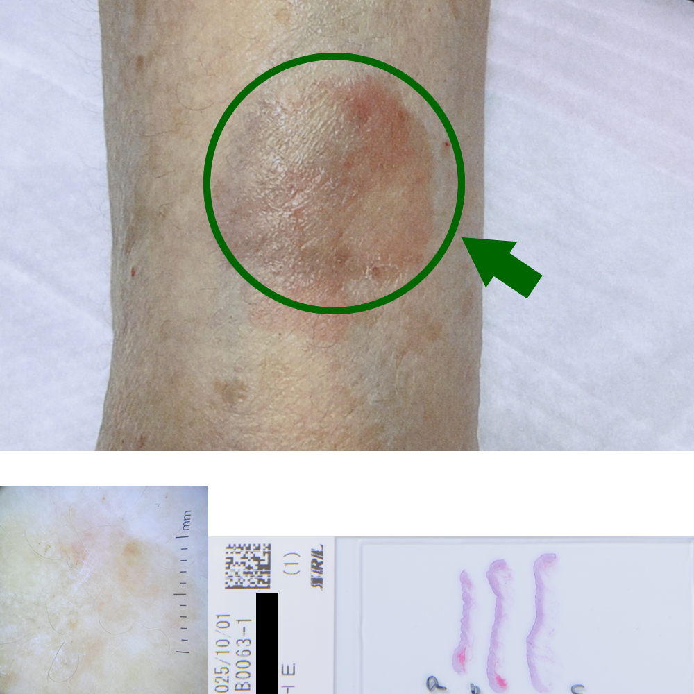 悪性黒色腫|82才女|左前腕部