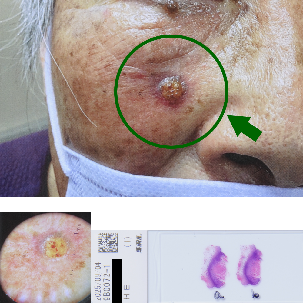 扁平上皮癌|78才女性|右頬部